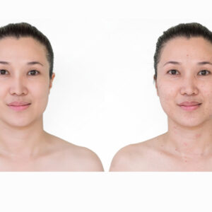 Skin Spots Treatment