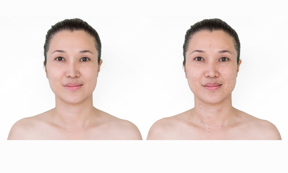 Skin Spots Treatment