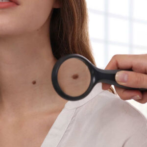 Laser Mole (Nevus) Treatment