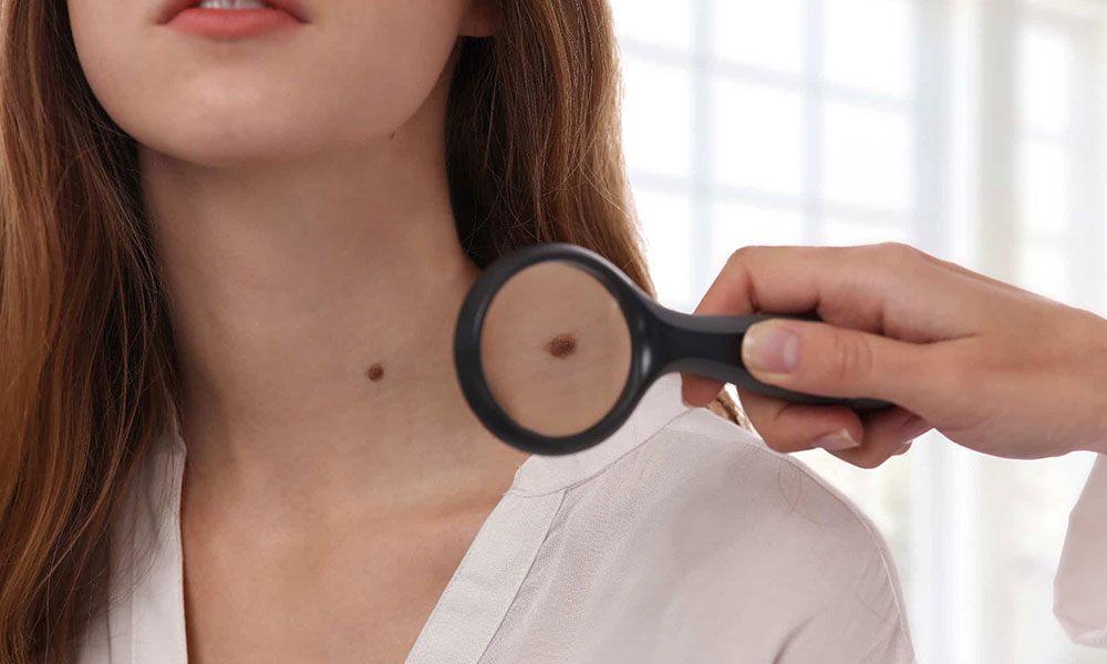 Laser Mole (Nevus) Treatment