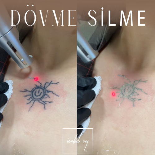 before-after